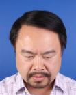 After Hair Transplant&nbsp;Front